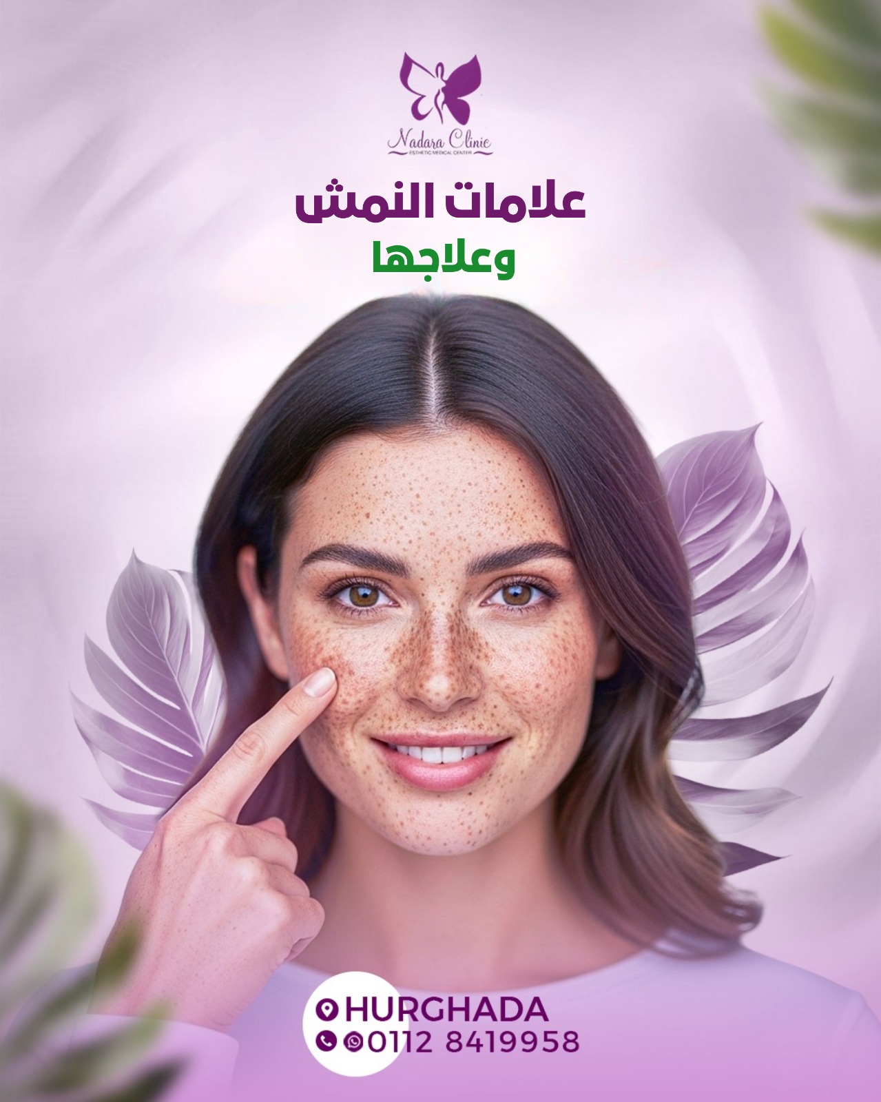 علامات النمش وعلاجها في الغردقة